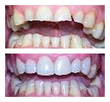 Chipped tooth before and after picture