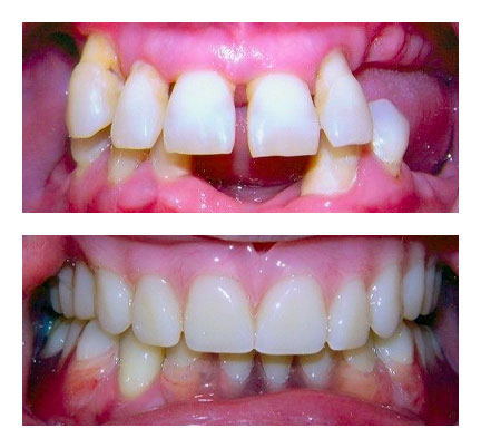 Dentures before and after picture